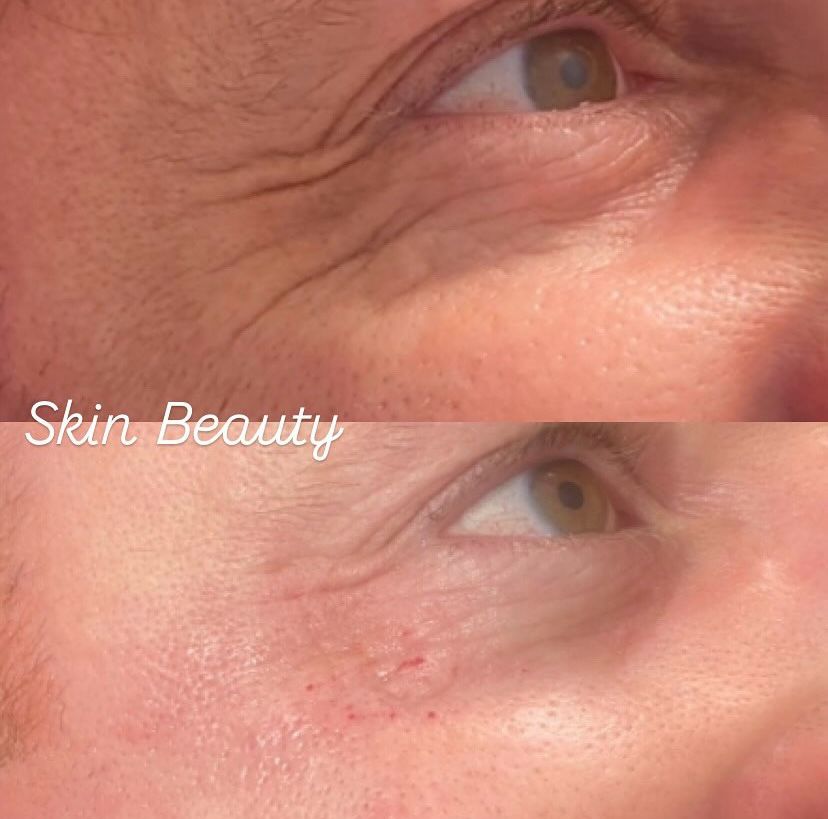 Before and after skin treatment result at Skin Beauty Wirral