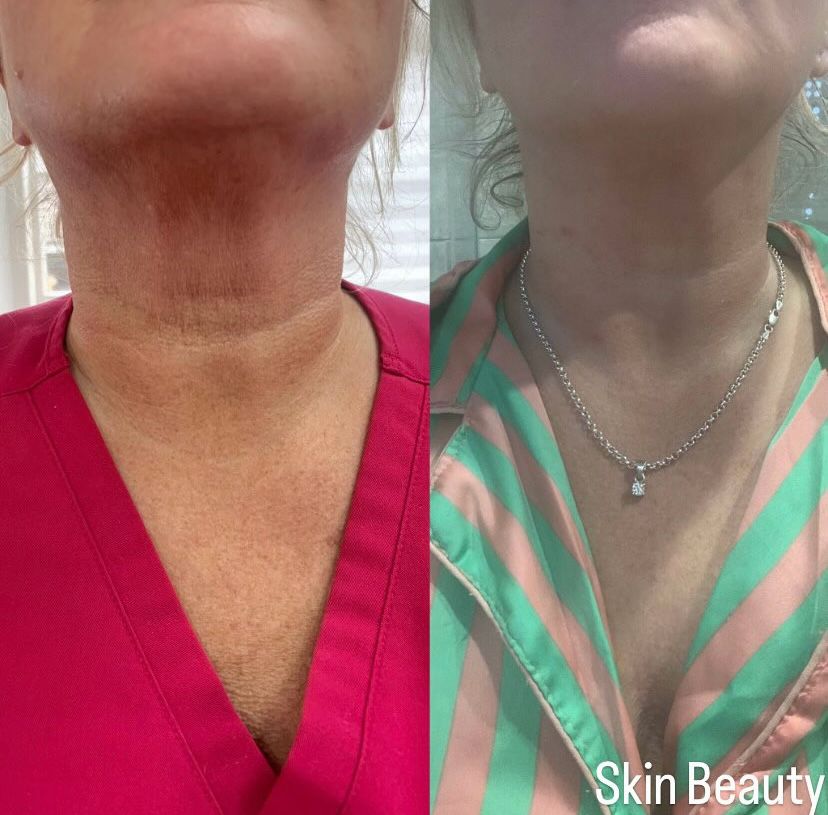Before and after — Skin smoothing with RF at Skin Beauty Wirral