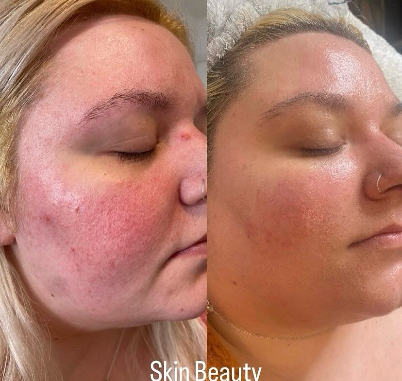 Before and after — Neck rejuvenation with Laser at Skin Beauty Wirral