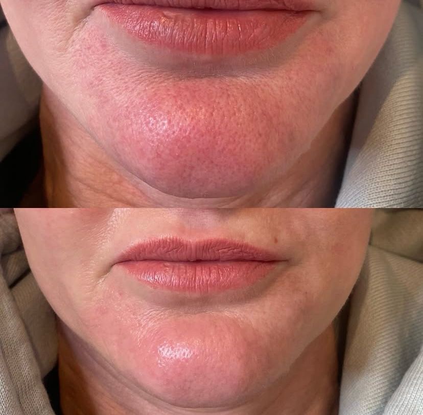 Before and after — Acne treatment with Microneedling at Skin Beauty Wirral